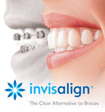 Invisalign is the best alternative to dental braces, Meet Dr. Koshki in Santa Monica, CA