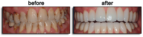  Porcelain Veneers / Lumineers treatment before and after results - Dr. Koshki