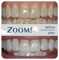 Know about Dental Clear Correction procedure whitening Service in Santa Monica.