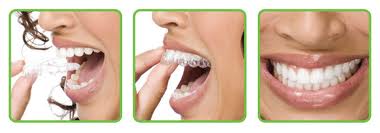 clear-aligners