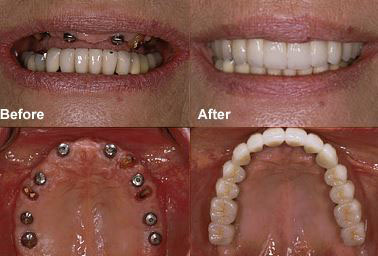 implants denture koshki recommending dentures