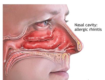 rhinitis