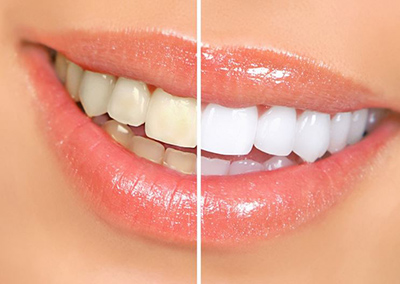 teeth-whitening-before-and-after-blog