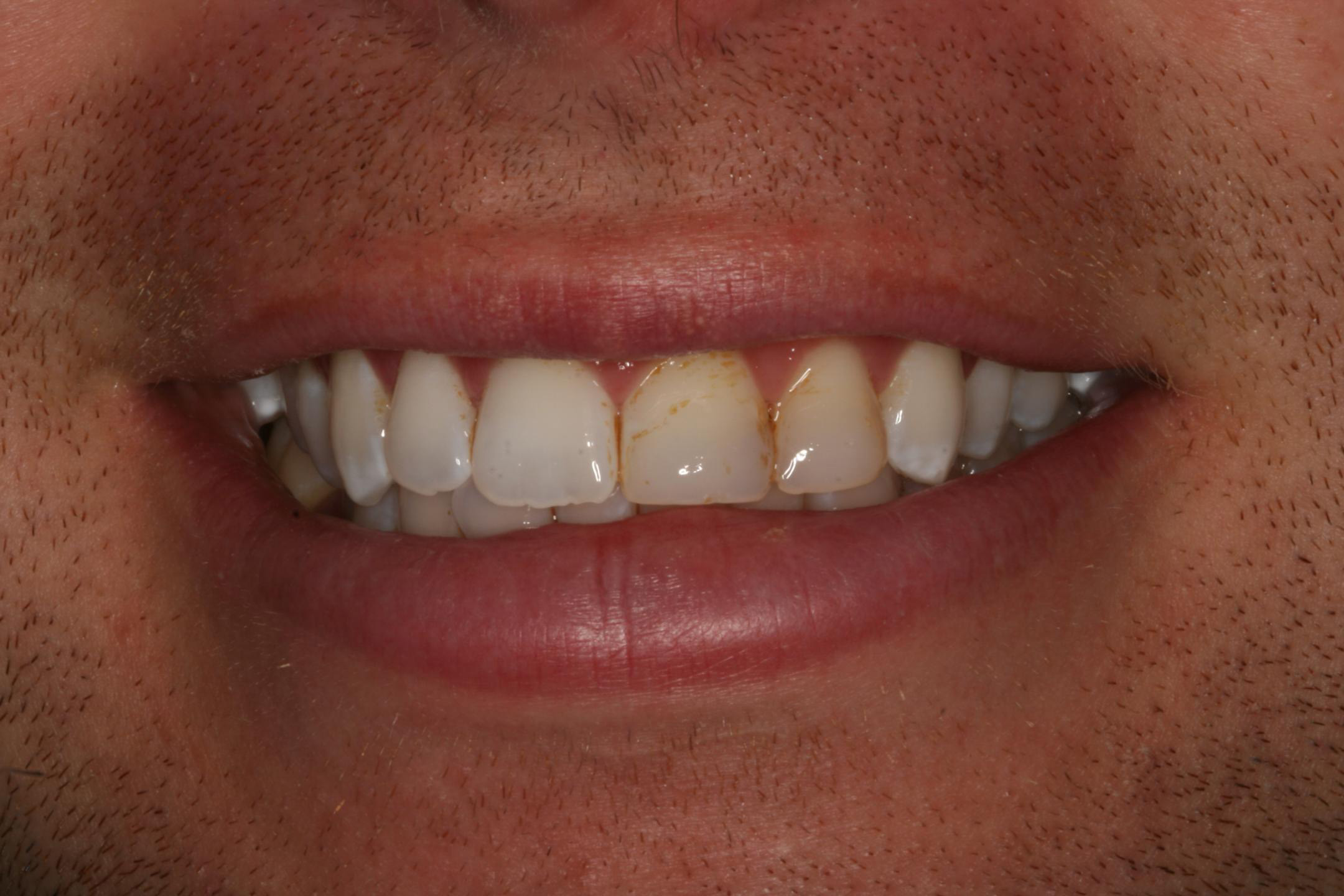 View Our Patients Smile Gallery | Santa Monica, Ca