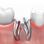 santa monica root canal