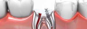 santa monica root canal